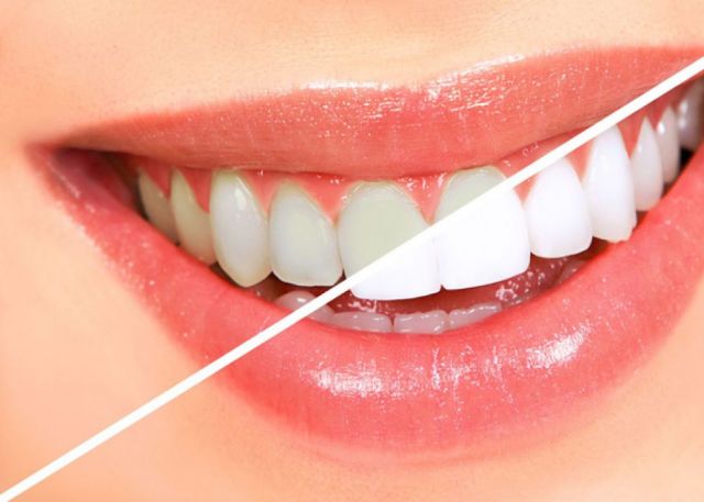 Clareamento Dentário (Laser)